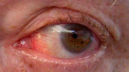 Glaucoma Glaucoma