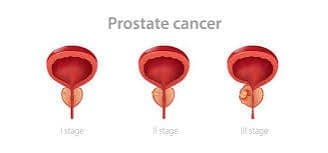 Prostate Cancer Prostate Cancer