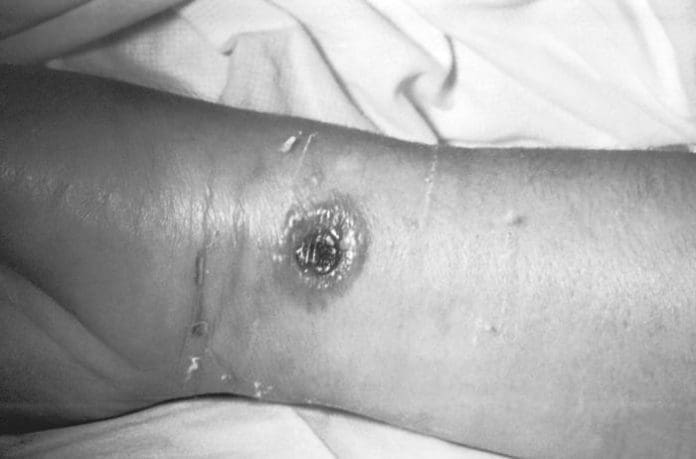 Anthrax outbreak