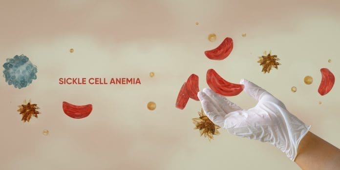 Sickle Cell Sickle Cell